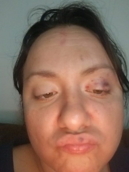 broken nose